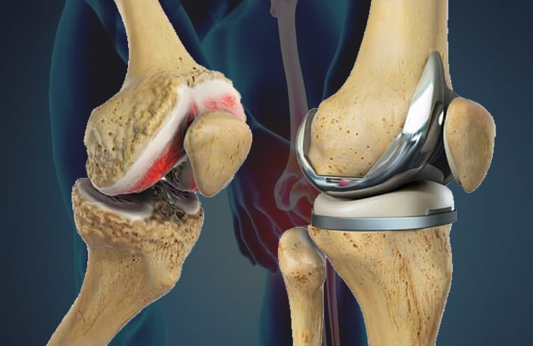 Knee Replacement surgery in Telangana